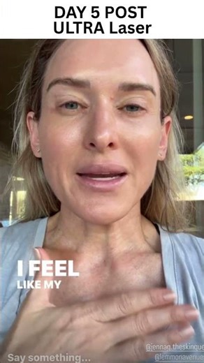 Day5-Follow me heal from an Aesthetic Laser-5 days after BBL laser & Ultra laser. #texasinjector