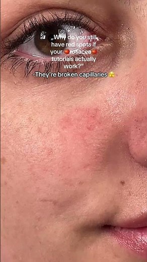 broken capillaries only disappear with laser #brokencapillaries #rosacea #rosaceaskincare