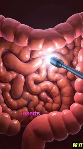 Inside Colon Camera? #marvel #didyouknow #facts #colon #healthfacts