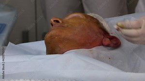 Thread lifting for a male patient is an innovative method of correcting face lifting with special ultra-thin and durable threads with multidirectional notches.