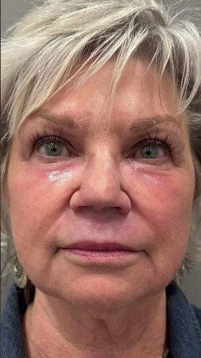 CO2 laser before and after