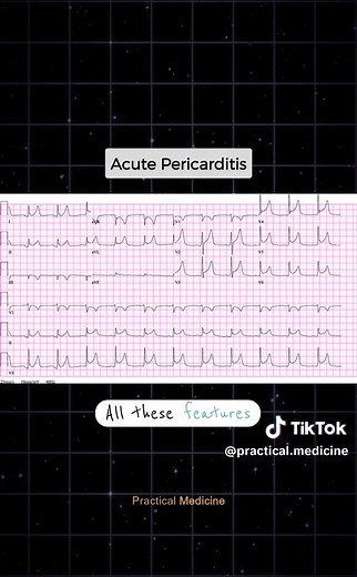 Understanding ECG Diagnosis for Chest Pain