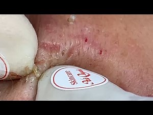 |359| Blackheads & Acne treatment 04/03/2021 (Full version)