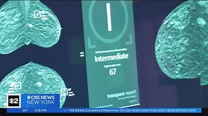 AI in mammography screening is safe and dramatically reduces Radiologist workloads