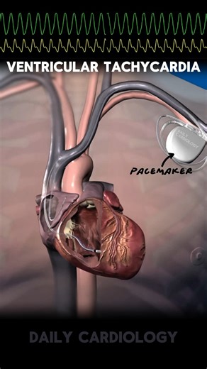 Pacemaker & ECG explained #shorts #pacemaker #ecg #cardiology #hearthealth #heartanimation