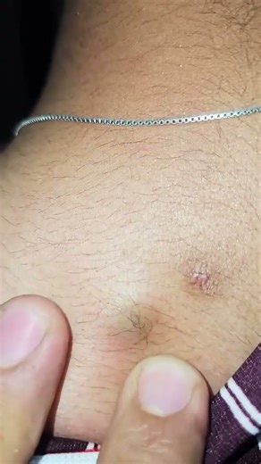 Sebaceous Cyst #medical