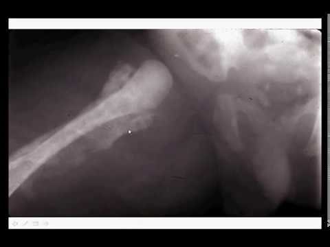 Musculoskeletal Infections Part 1