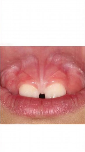 Upper Lip Tie Class 1 - 4 #shorts ‪@fauquierent‬