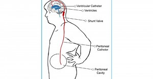 VP Shunt: Purpose, Preparation, Procedure, Aftercare, Results, Risks and complications