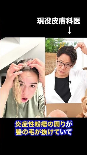 [Sebaceous cyst] If it appears on the scalp, it may cause hair loss.