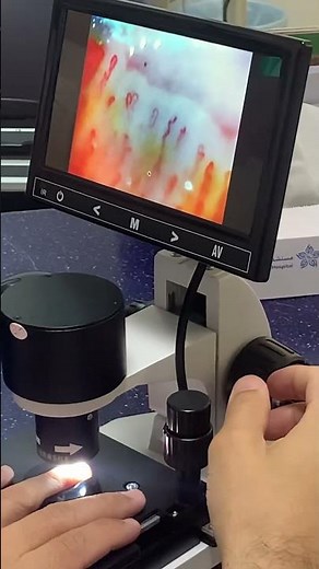 Scleroderma Test#Nailfold Capillaroscopy#demonstrate by Dr.Waleed Consultant Scleroderma