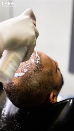 Safe Head Wash After Hair Transplant Day by Day