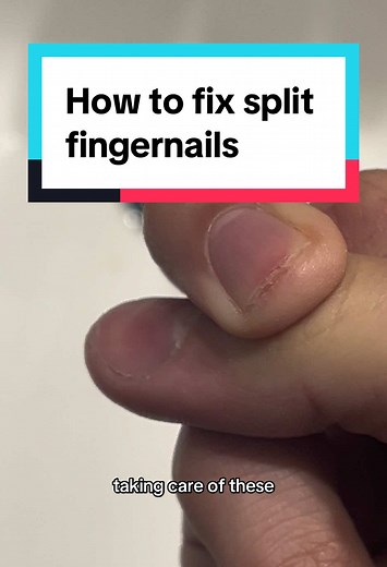 Effective Ways to Treat Split Fingernails and Prevent Pain