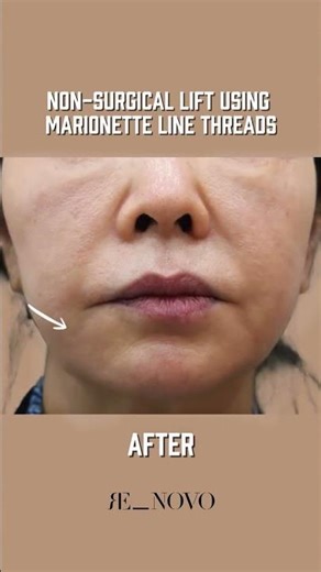 Marionette lines can pull the entire face downward — creating that tired, heavy expression.