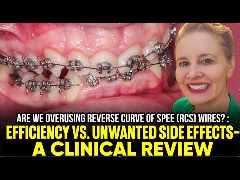 The Dangers of Overusing Reverse Curve of Spee Wires (RCS) in Braces or using them at the Wrong Time