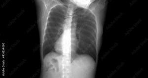 Chest x-ray 3D rendering from data of CT Chest scan.