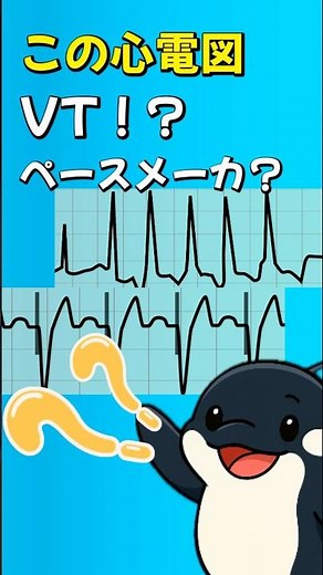 VT⁉️ペースメーカー波形⁉️見分け方のコツ❗️part51 #心電図検定 #心電図 #総合診療 #看護師 #訪問看護 #シャチ #おすすめ #看護学生 #看護