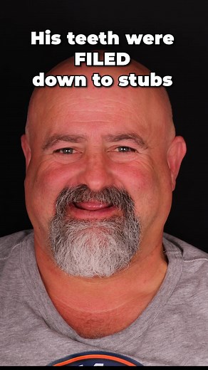 15K views · 58 reactions | A NAIL FILE?! 醴 He tried fixing his teeth himself… and it did NOT go as planned. #SmileMakeover #DentalImplants #OralHealth #ToothDamage #HealthyTeeth | Nuvia Dental Implant Center | Facebook