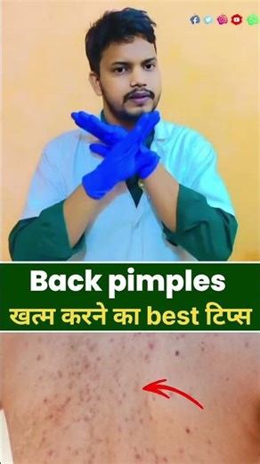 back pimples remove kareb | home remedy #homeremedies #skincare #skin
