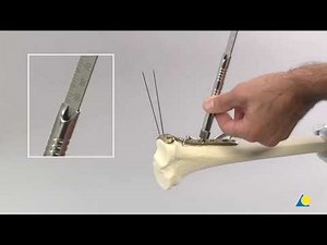 Principles of Internal Fixation with Screws and Plates