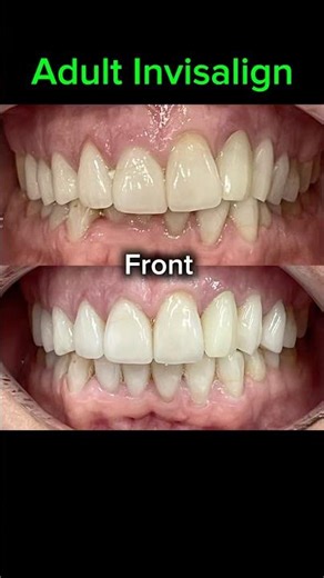 Adult Invisalign Before and After in Fort Lauderdale Orthodontics Office
