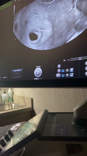 6 Week 2 Days Ultrasound with Strong Heartbeat at 128bpm