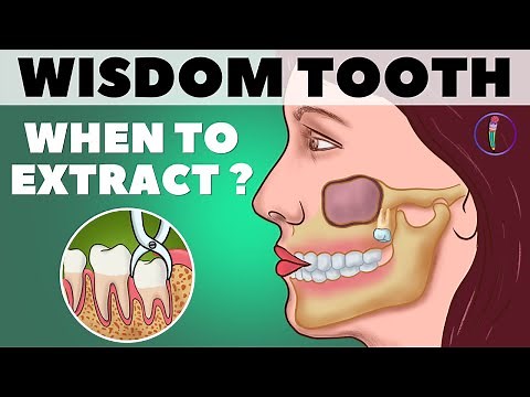 Wisdom Teeth Removal / When to extract Wisdom teeth (Third molar) / Animation // Medinaz