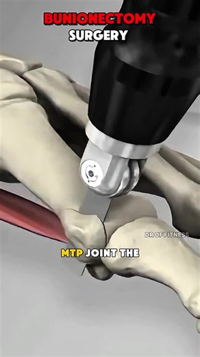 How Bunionectomy Surgery Is Done(3D Animation) Bunionectomy is performed to treat Bunion, a painful bump at the base of the big toe. Surgeons remove the bony bump and realign the toe joint. Screws or plates may be used to keep the bone in the correct position during healing. #bunion #bunionectomy #footsurgery #medicalanimation #3danimation