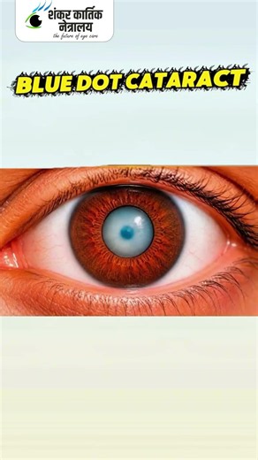 Different Types of Cataracts You Should Know | Sankar Kartik Netralaya | 6390007621