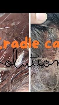 Fast Acting, All Natural, Cradle Cap Removal