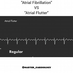Fibrillation auriculaire vs flutter auriculaire . . . Crédit vidéo : @Master_cardiology | Dr Brahim Réa
