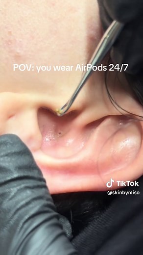 AirPods Causing Ear Blackheads? How to Treat