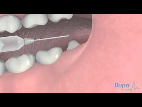 How a wisdom tooth is removed