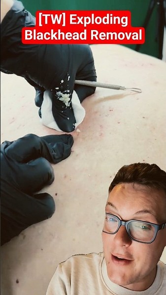 EXPLOSIVE BLACKHEAD REMOVAL - This Is Why You Wear Gloves #shorts