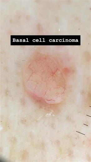 Are you a health professional and want to learn dermoscopy? 🔍 I recommend the certificate dermoscopy courses by @healthcert Use discount code DRJOHN for a 15% discount. Are you from the U.S. 🇺🇸 and want to learn the basics of skin cancer medicine and how to introduce it into your practice? I recommend the Skin Cancer Medicine Accelerator Program by MoleScan. Use discount code DRJOHNUS See links in bio for more information. #dermoscopy #skincancer #skincancerdoctor #buderim #sunshinecoast #mel