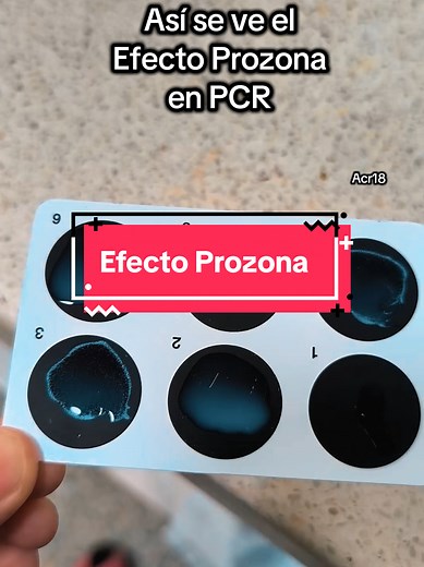 Efecto Prozona en Medición de PCR y sus Consecuencias
