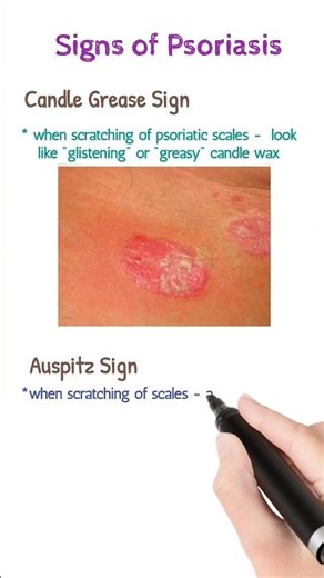 Candle Grease sign & Auspitz sign of Psoriasis 🩺 #aiims #jipmer #rrb #mrb #all competitive exams 🩺