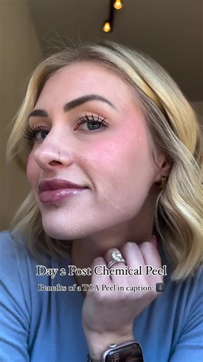 Benefits of a Trichloroacetic Acid Peel Explained