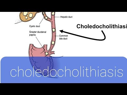 choledocholithiasis