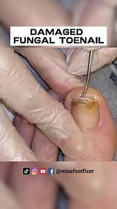 DAMAGED FUNGAL TOENAIL [ Discoloration of the Nail ] FULL TREATMENT BY MISS FOOT FIXER
