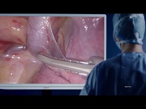 Olympus 4K Ultra High Definition System – Olympus Surgical