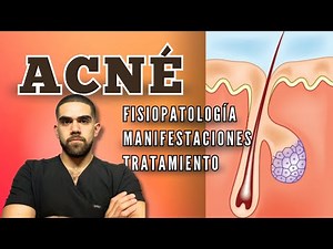 Acné: fisiopatología, clasificación y cómo tratarlo