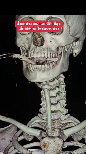 น้องไม่รอด น่าสงสารพ่อกับแม่มาก เด็กอายุ14 มอไซต์ชนรถพ่วง ขอแสดงความเสียใจกับครอบครัวน้องนะคะ #อุบัติเหตุ #Rip #ขอแสดงความเสียใจด้วยค่ะ