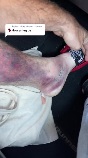 Reply to @stinky_skater #bruise #healing #ouch