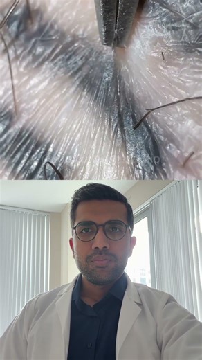 Ingrown hair removal procedure