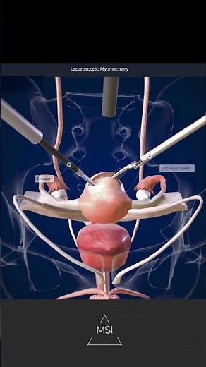 Laparoscopic Myomectomy