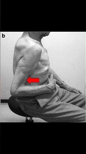 Belly Press Test #meded #shoulderpain #athletictraining #physiotherapy