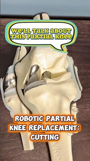 How a Robotic Arm Helps Me Perform a Partial Knee Replacement