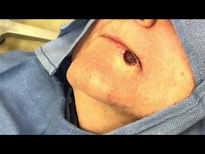 Skin Cancer Surgery - Initial layer excision - skin cancer near lip