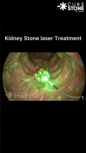 Satisfying Kidney Stone Removal 😱 (Laser Lithotripsy Animation)